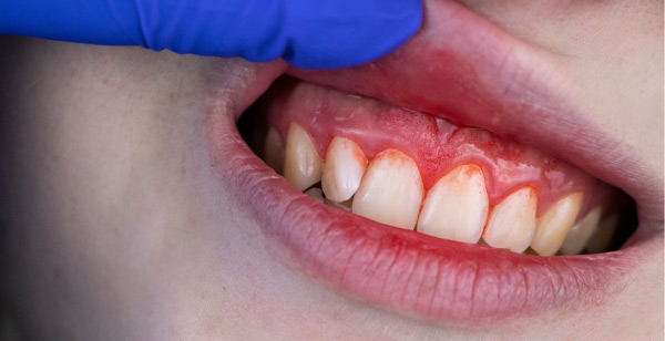 Doctor con guantes levanta el labio de paciente para revisar sus encías, ls cuales están inflamadas, de color rojo intenso y que sangran o sangrantes. Todos, síntomas de la gingivitis dental, una enfermedad periodontal