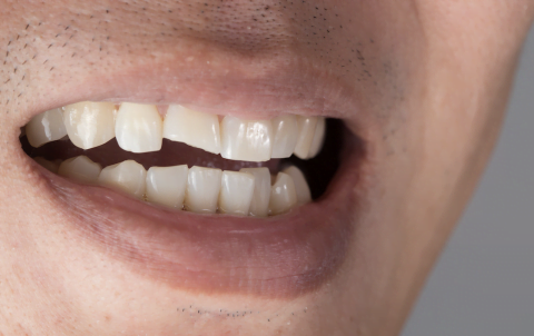 dientes feos