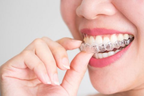 Lo último en ortodoncia estética