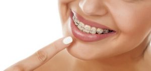Función del Alambre Trenzado en Ortodoncia - Clínica Dental Everest
