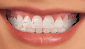 ortodoncia-Bracket-ceramicos