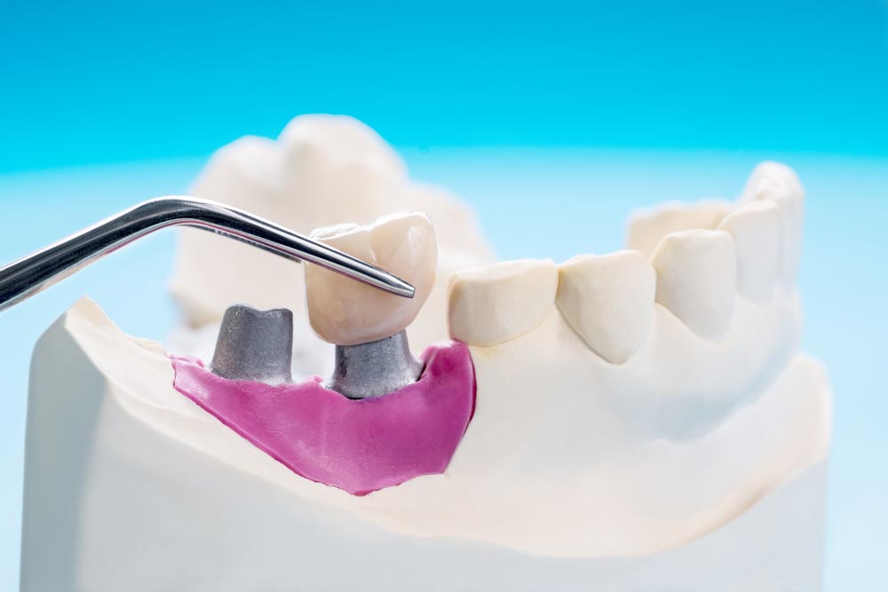 Implante dental: Solución a la falta de hueso | Clínica Odontológica