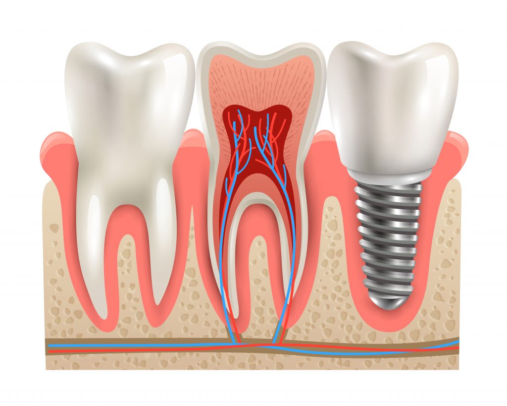 Diferencias entre una funda y una corona dental
