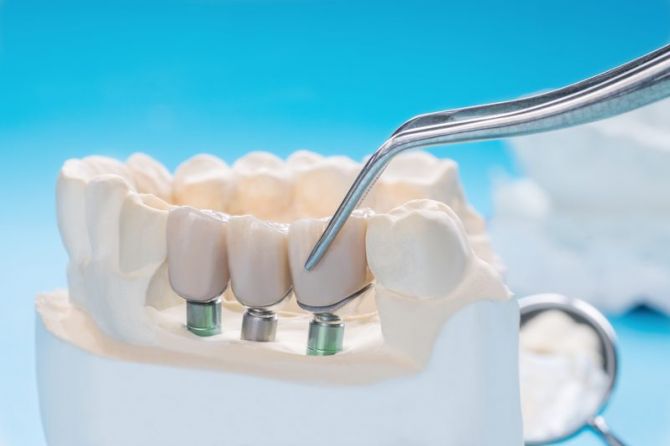 puente dental