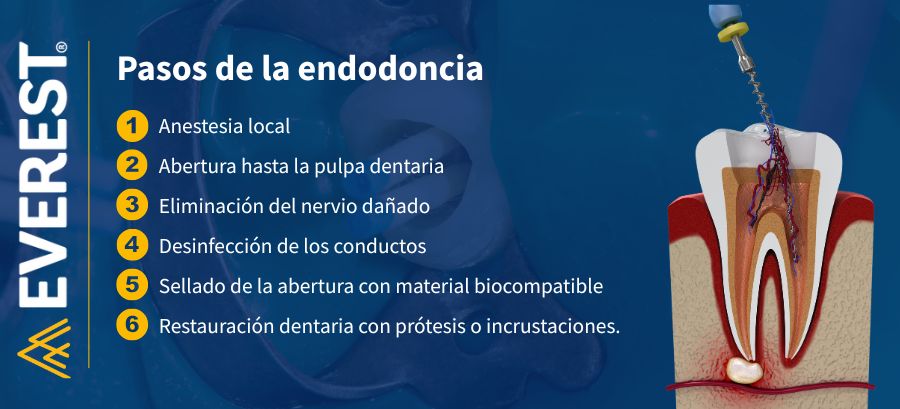 infografía pasos o etapas o fases de un tratamiento de conducto o endodoncia. Contexto: diente o muela negro después de una endodoncia