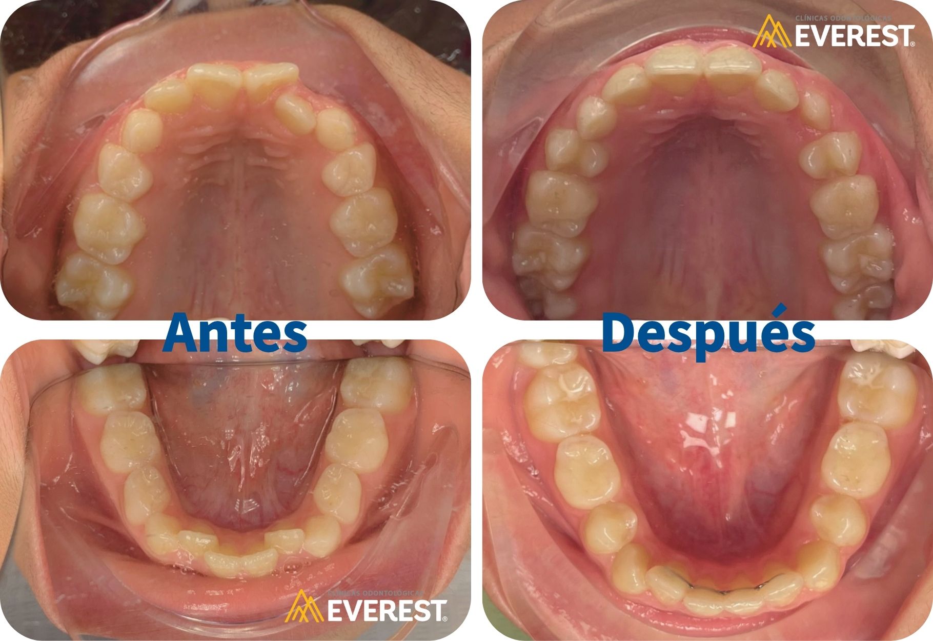 Caso clínico con alineadores invisibles antes y después en Clínica Everest