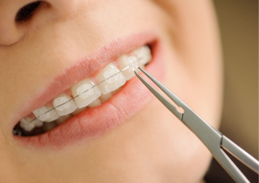 tipos de Brackets. Brackets de zafiro