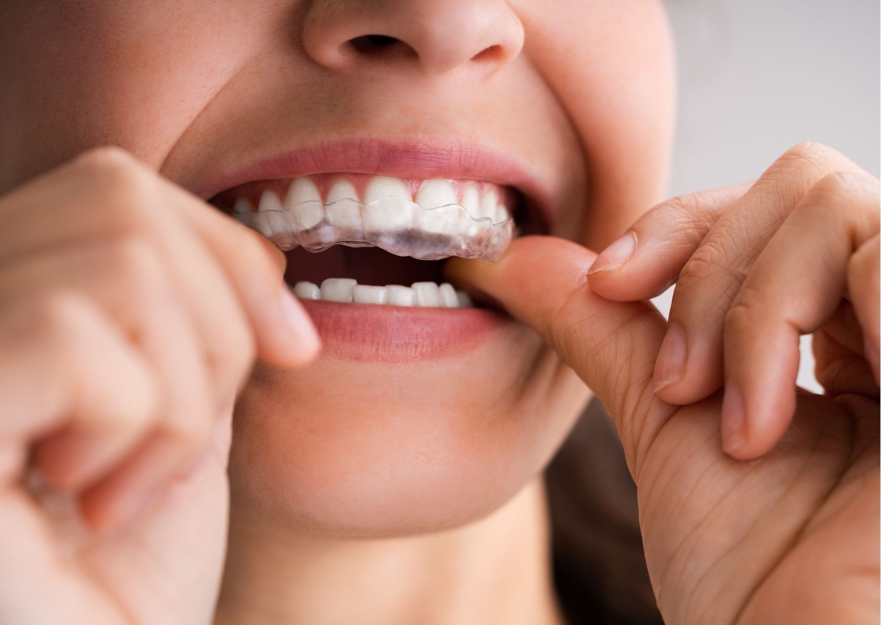 niña poniéndose una férula de descarga de silicona en sus dientes para evitar el bruxismo infantil