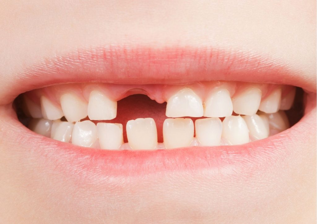 imagen muestra la boca de un niño que ha perdido un diente de leche. Mantenedor de espacio dental