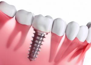 Ilustración con imagen de implante dental entre otros tres dientes. Cuidado de los implantes dentales
