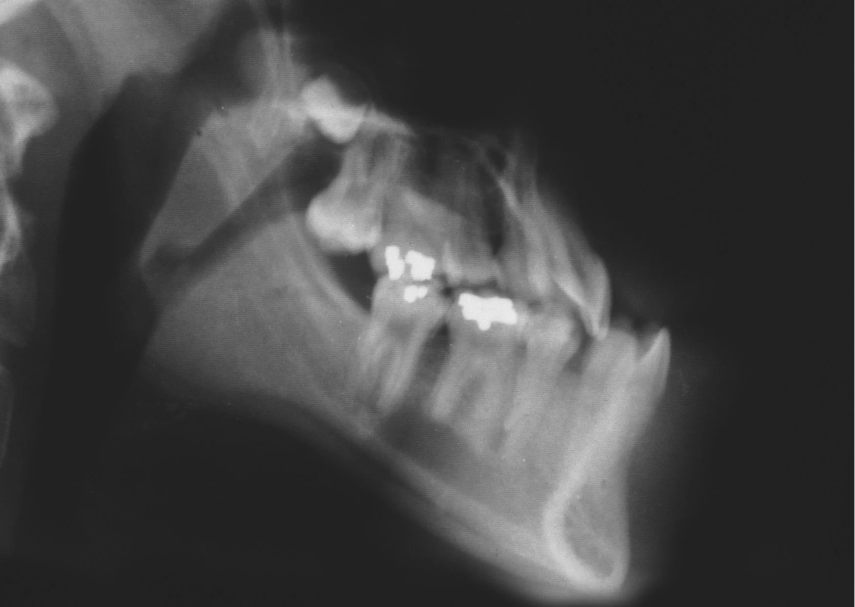 ferpa on X: prognatismo mandibular (maxilar inferior proeminente
