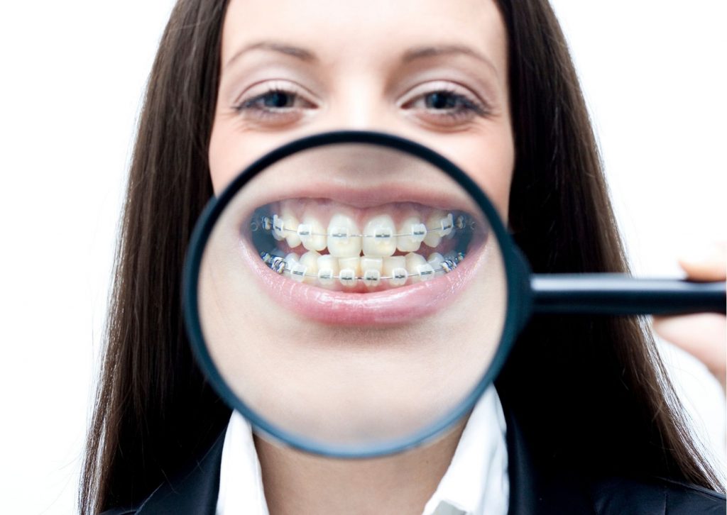 Mujer adulta con una lupa en su boca que amplía sus dientes con brackets metálicos. Brackets después de los 40

