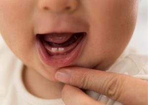 Primer plano a boca de bebé, donde se ve un dedo tirando su labio inferior para dejar ver dos pequeños dientes y la lengua. Tema: frenillo lingual corto