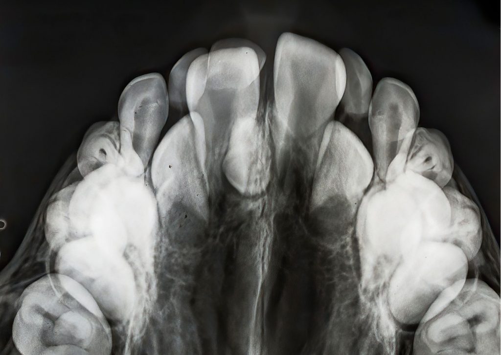 imagen de radiografía donde sale la arcada superior de la dentadura con dientes de más