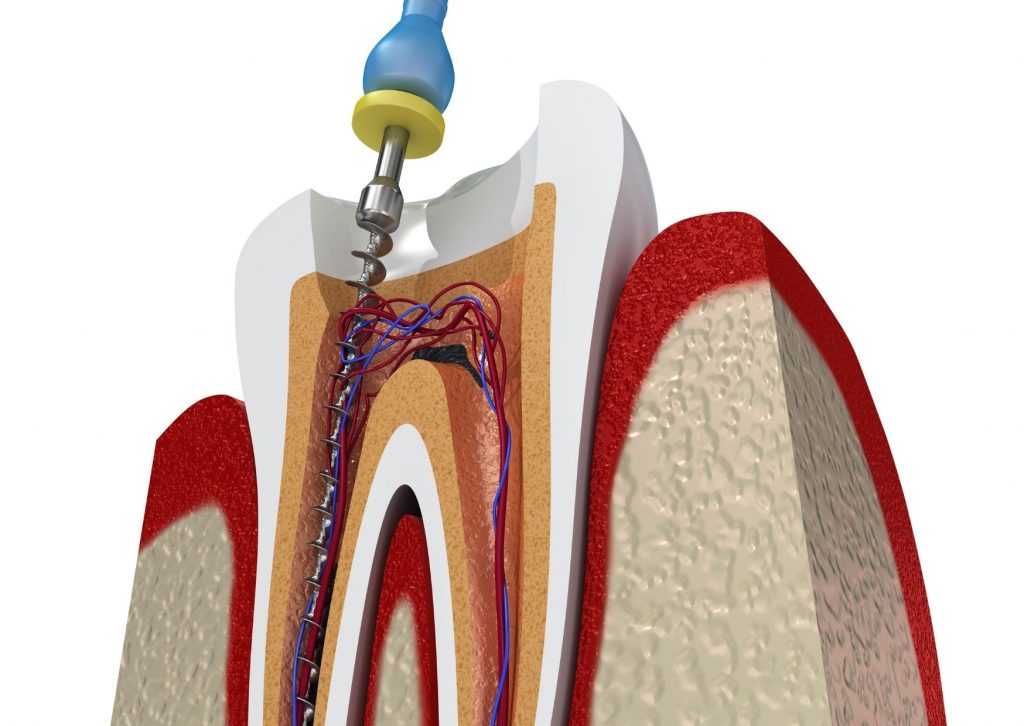 Ilustración de un procedimiento de endodoncia, para salvar un diente con caries profunda.