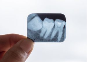 Dedo de dentista sujetando una radiografía-Periapical