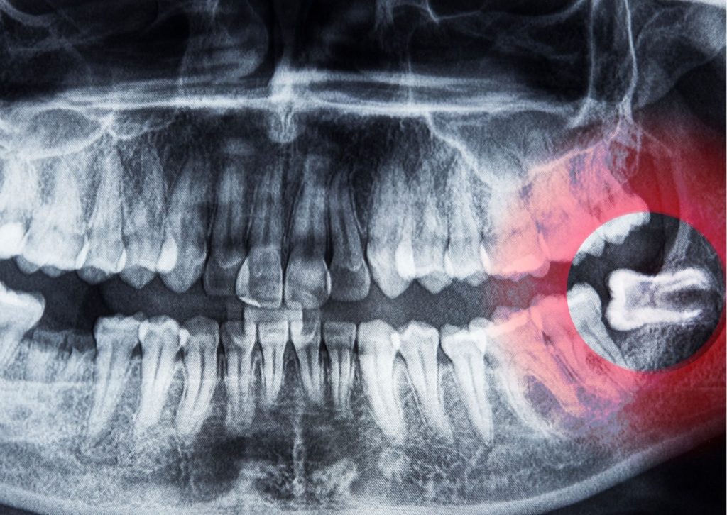 Radiografía dental panorámica que muestra con un círculo rojo, una muela retenida en el maxilar inferior izquierdo. tema: tipos de radiografías
