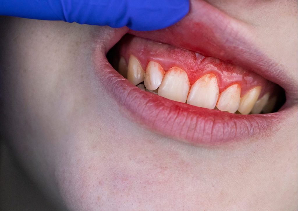 Primer plano de una boca. Dedo con guante azul de latex levanta el labio superior para mostrar encías rojas y con sangre. Tema: el color de las encías