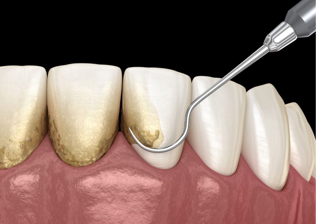 Imagen 3D de una profilaxis o higiene dental profesional. dientes sueltos