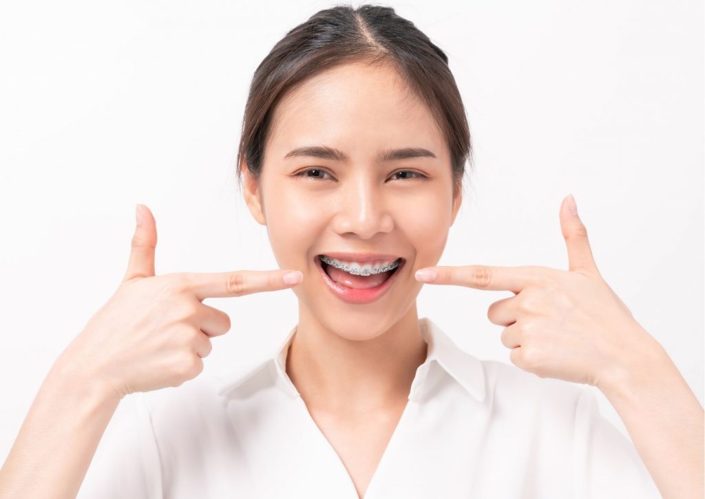 Mujer con moño sonríe a la cámara, apuntando con sus dedos índice los dientes con brackets. Tema: beneficios de la ortodoncia en adultos