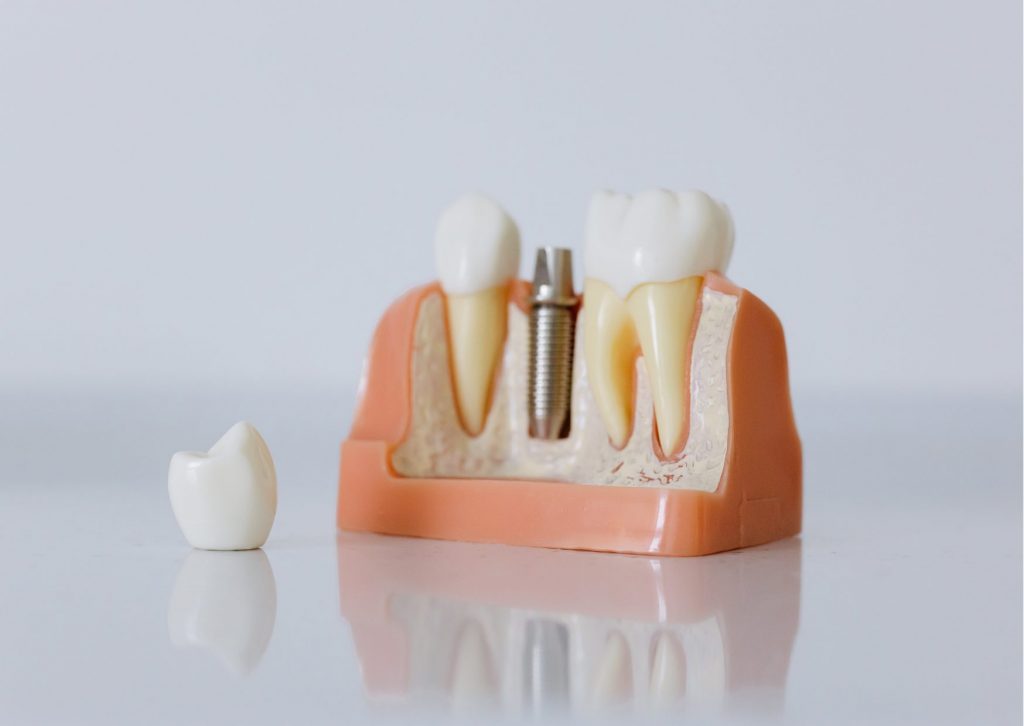 imagen 3d de molde de encía con tres piezas dentales: un diente, un tornillo de implanyte dental y una muela. Al costado yace la corona del implante dental Tema: Cuidados después de un implante dental.