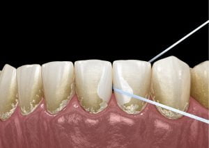 Imagen 3d de cuatro dientes inferiores. En dos de ellos se ve un hilo dental entre medio. Tema: detectar caries iterproximales.