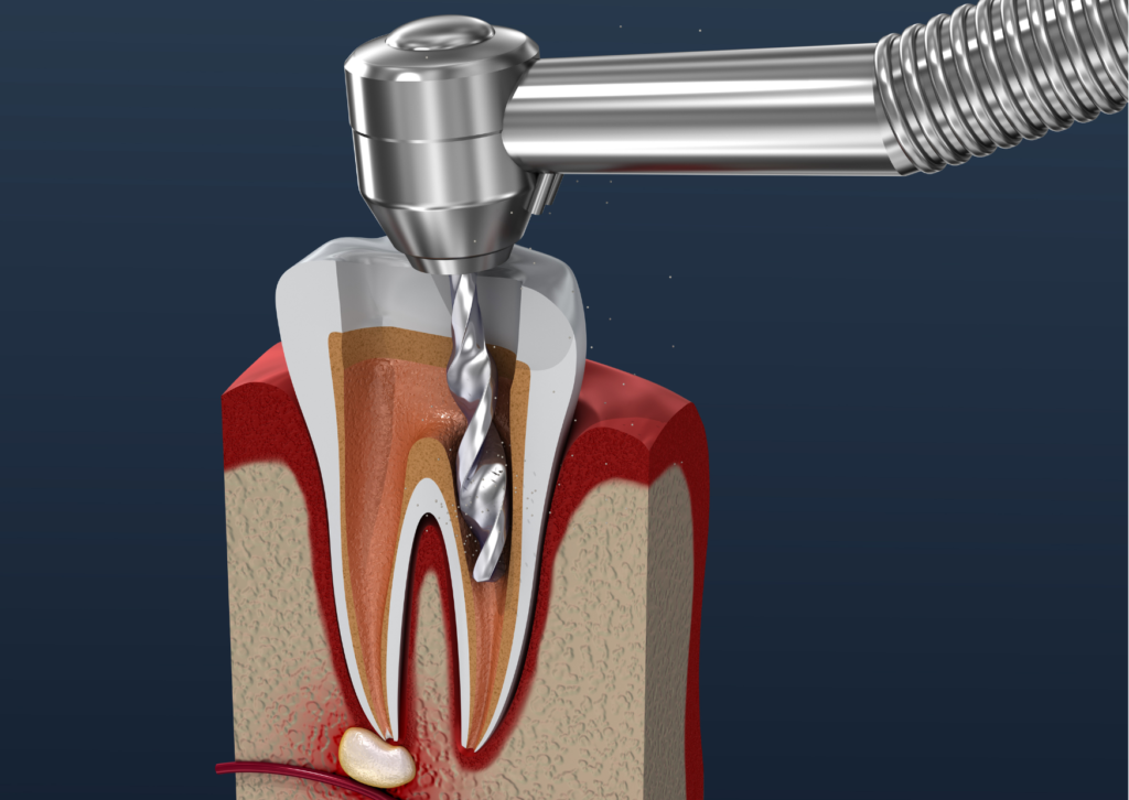 ilustración 3D de un tratamiento de conducto radicular. 