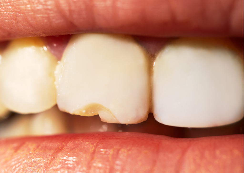 Primer plano a dentadura de niño o niña que muestra uno de los dientes frontales astillado. Tema: fractura dental en vacaciones de Blog Everest Life