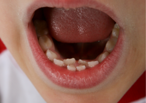 Primer plano de boca de niño abierta donde se aprecian dientes de más en el maxilar inferior. Tema: Dientes Supernumerarios de blog Everest Life.