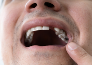 Primer plano de la boca abierta de un hombre al que le falta un diente incisivo. Tema_ consecuencias de la falta de dientes, blog Everest Life