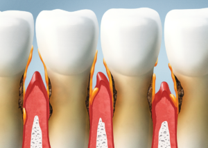 Ilustración que muestra dos dientes con sus respectivas encías, las cuales se muestran retraídas. Tema: Tratamiento para las encías retraídas para blog de Everest Life
