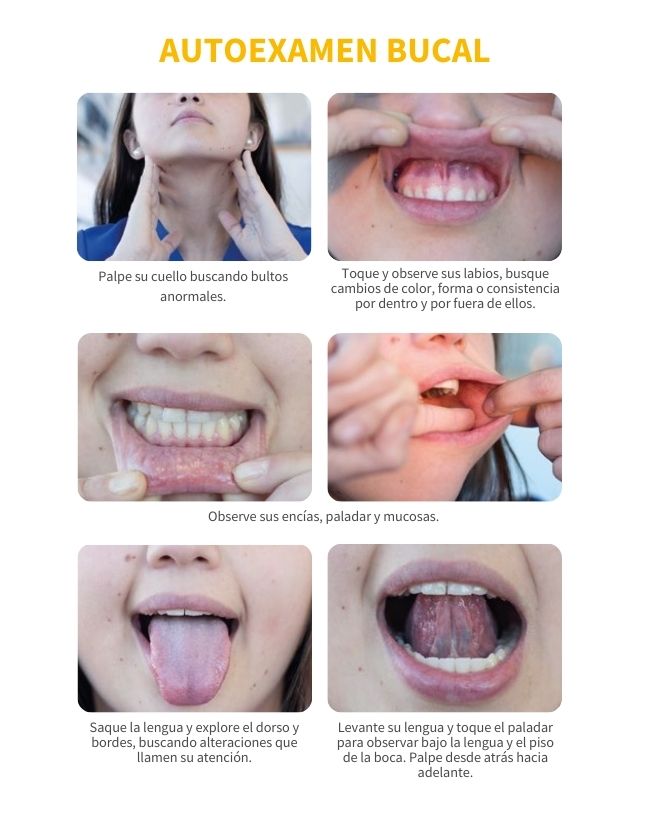 Guía de autoexamen de cáncer de boca, cáncer bucal, cáncer oral o cáncer de la cavidad bucal. Imágenes del Minsal de Chile