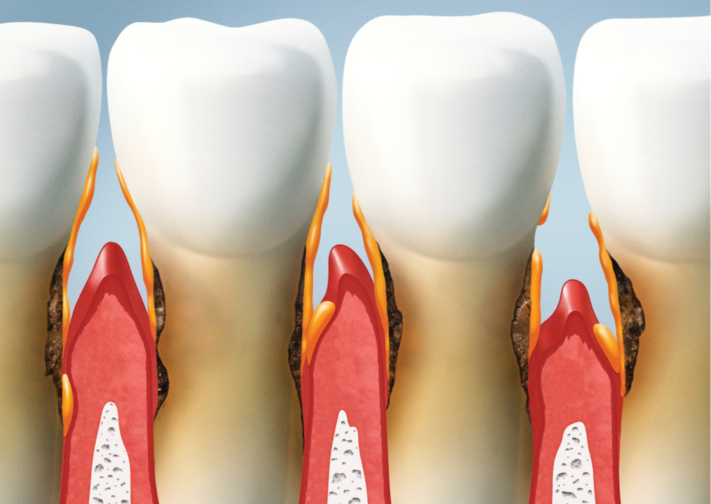 Modelo 3D que muestra como se ven las encías retraídas, muy por debajo de la línea del esmalte dental