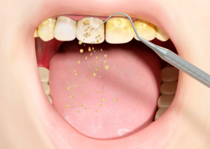 eliminación de sarro en dientes humanos mediante terapia periodontal convencional utilizando herramientas dentales ilustración 3d