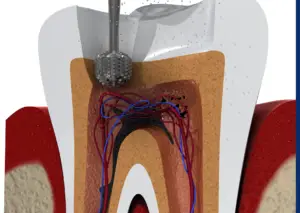 Proceso de endodoncia donde se limpian los conductos radiculares infectados