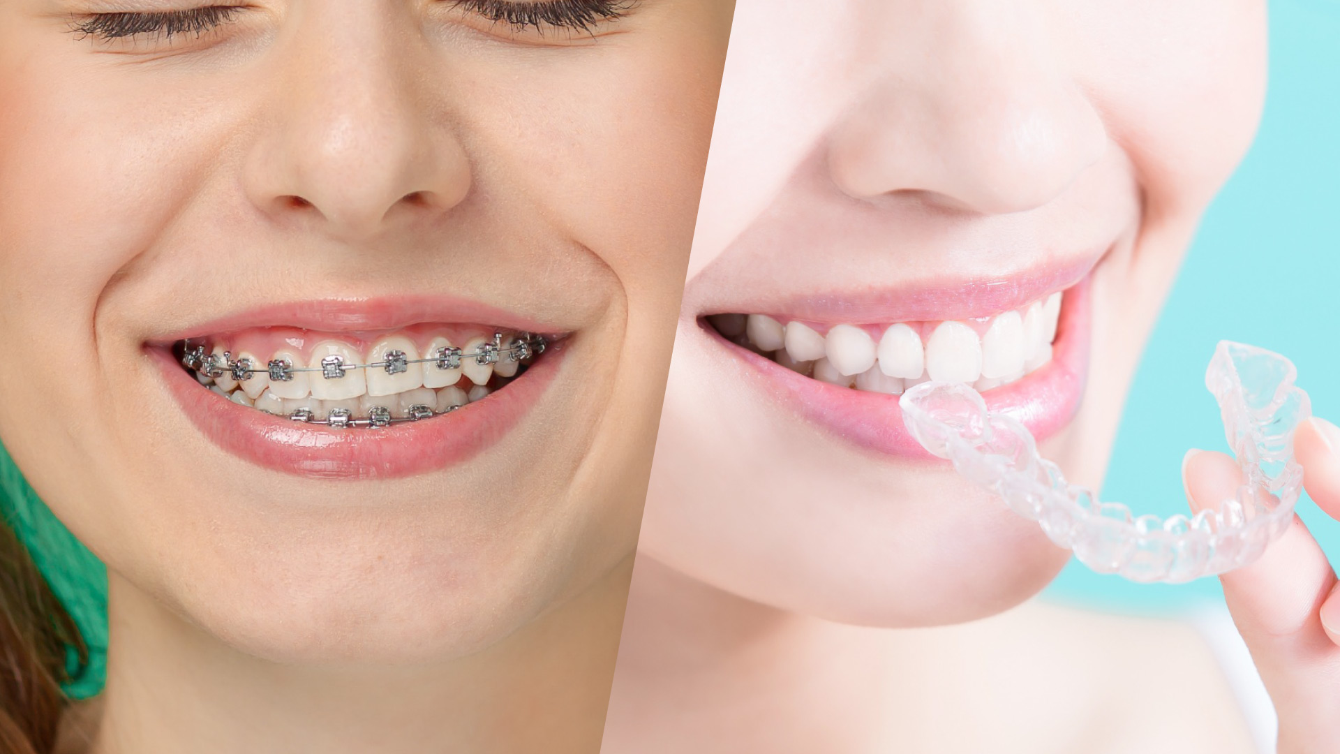 Tratamiento de Ortodoncia: Brackets vs Alineadores dentales: