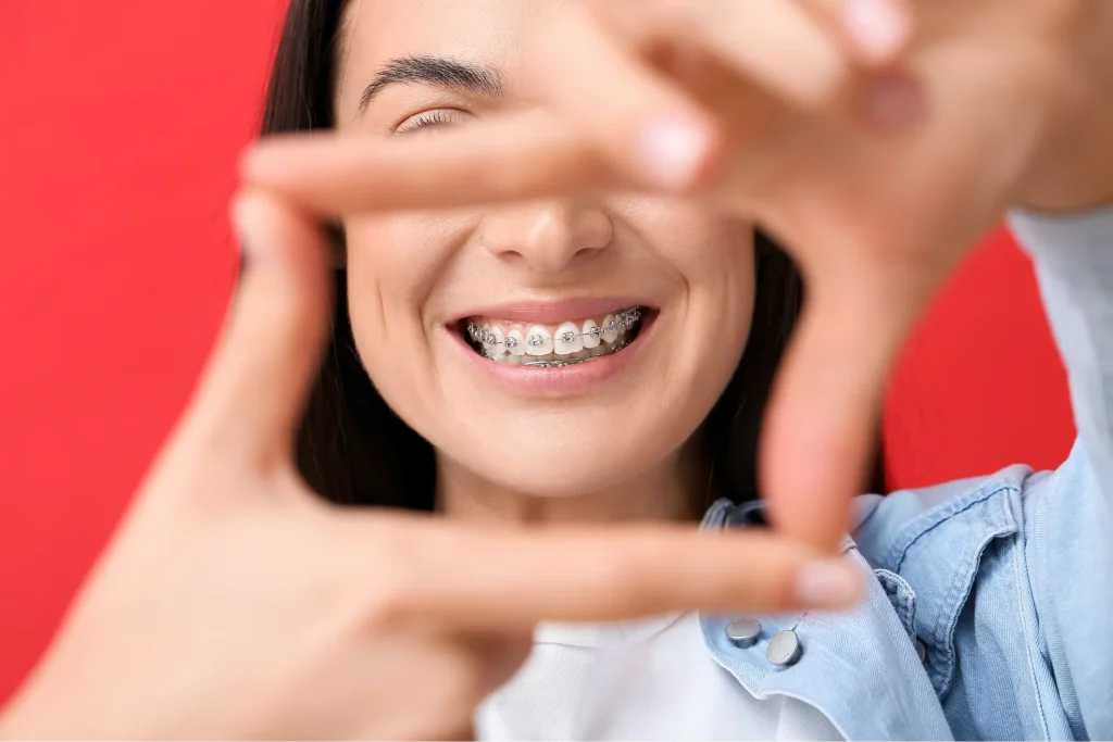 Beneficios de los brackets ortodoncia tradicional