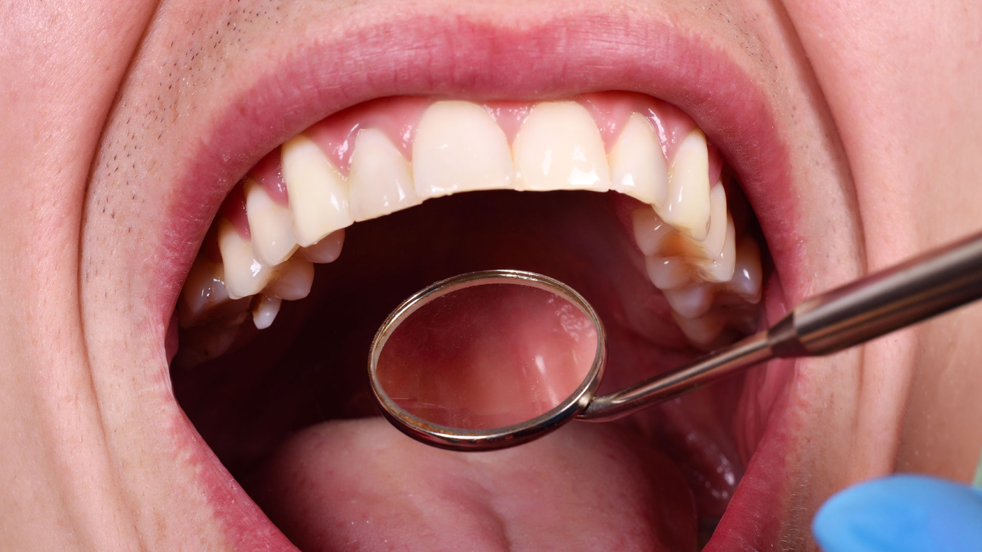 Implantes y periodontitis