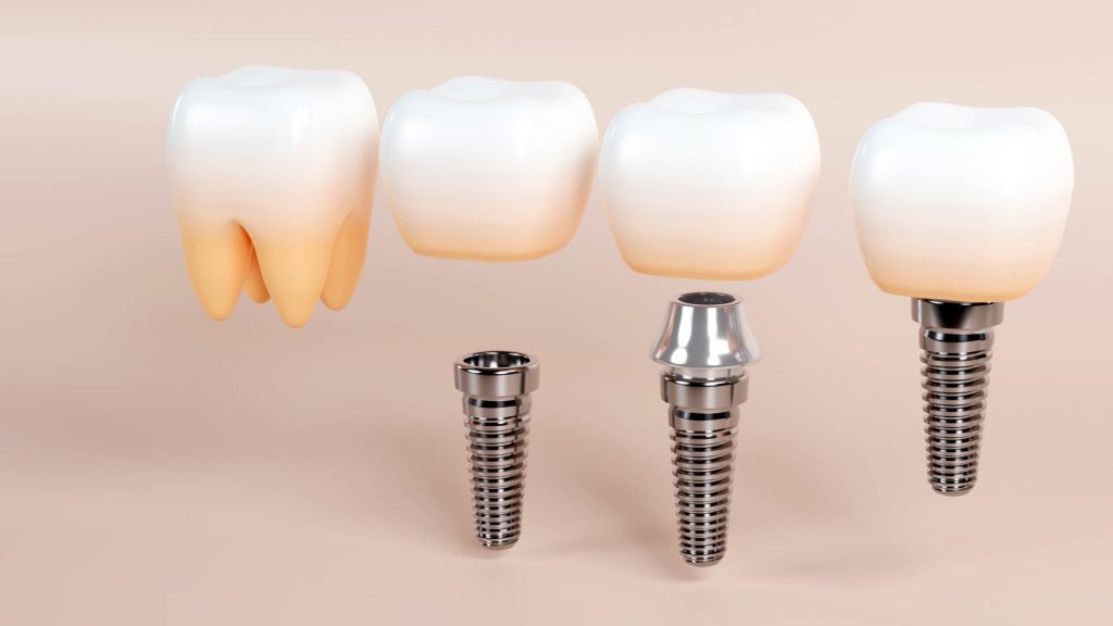 Implante dental con corona