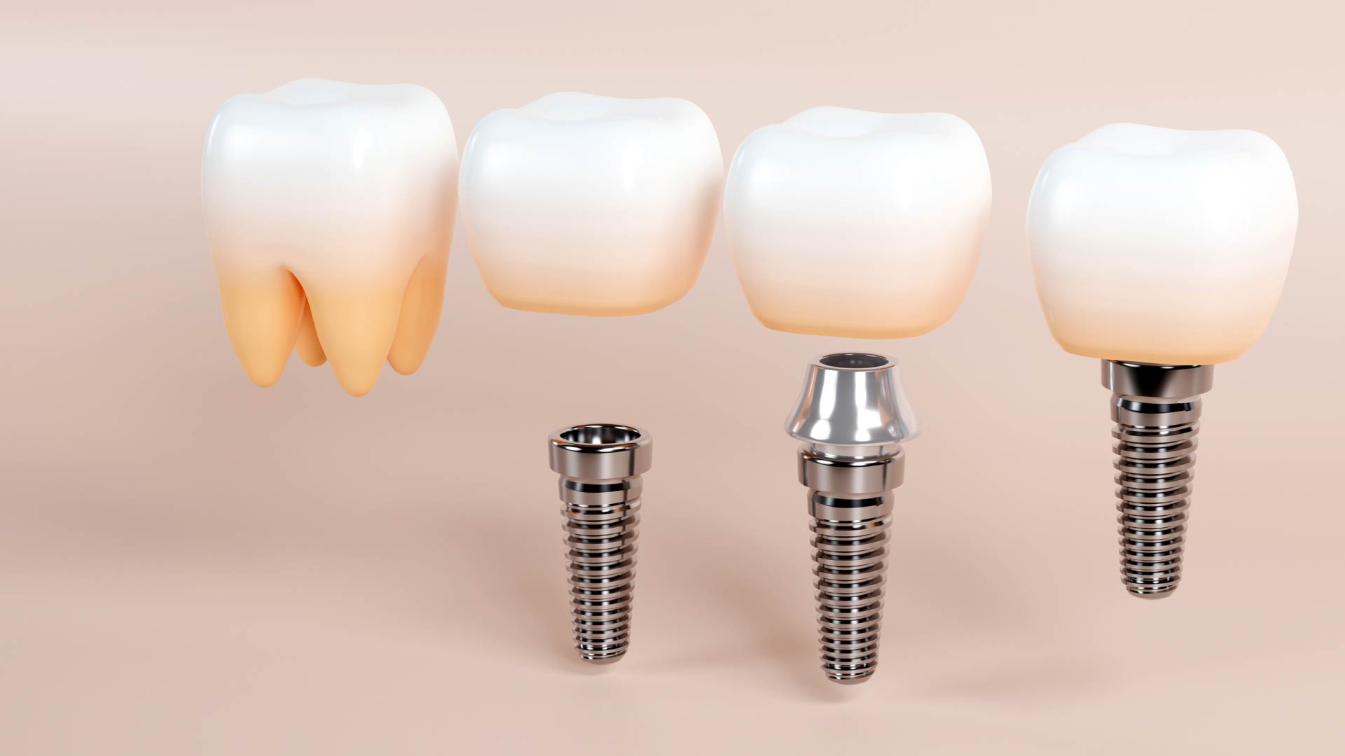 Implante dental con corona