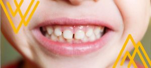 Niño con dientes de leche: contexto: caries blancas en los dientes