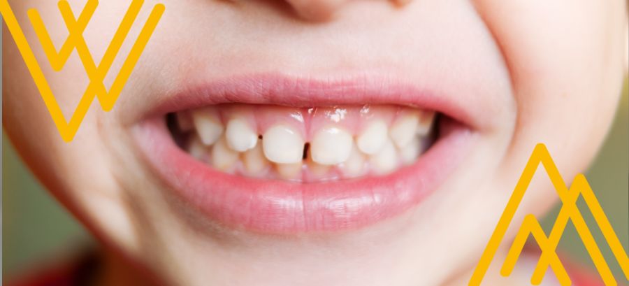 Niño con dientes de leche: contexto: caries blancas en los dientes
